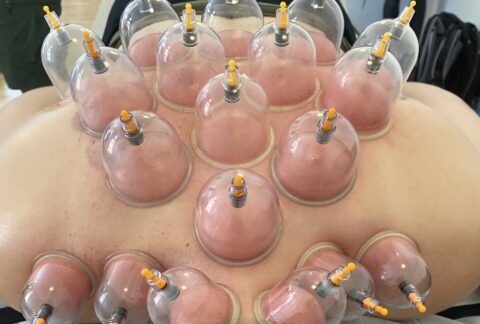 Cupping Terapi