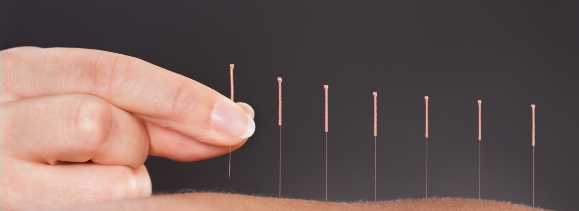 Find Balance med Akupunktur i Hillerød!
