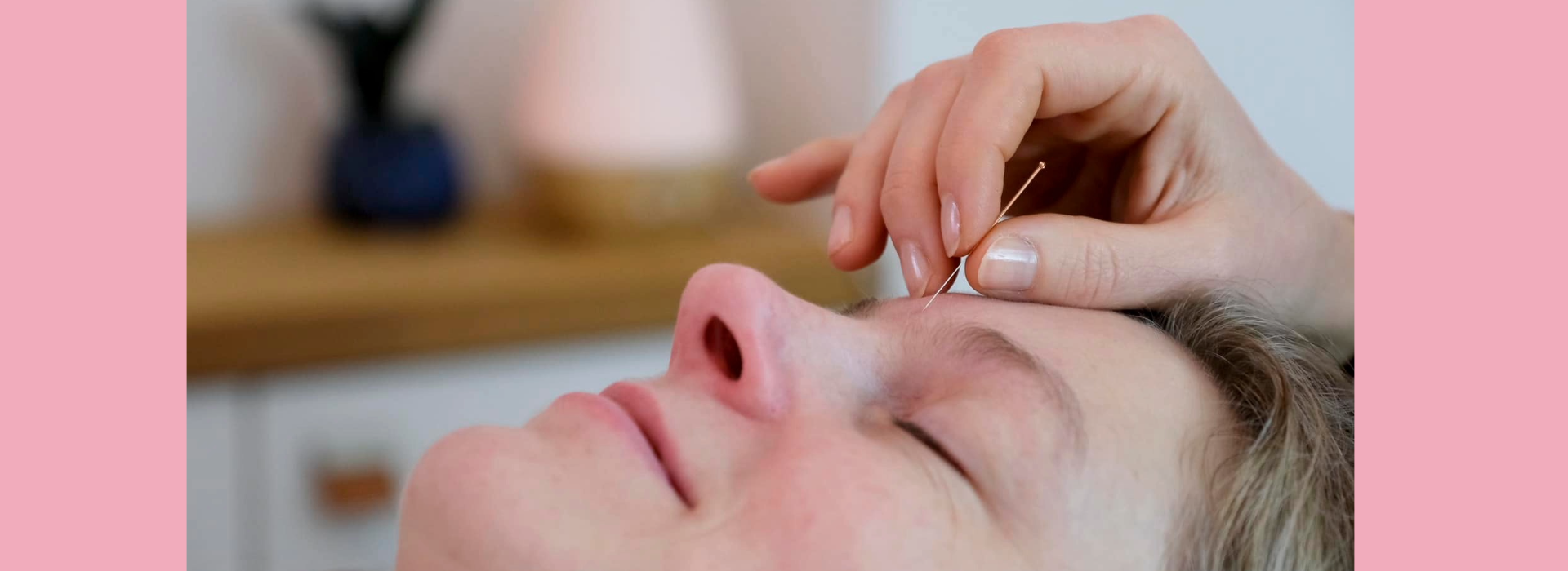 Kosmetisk Akupunktur